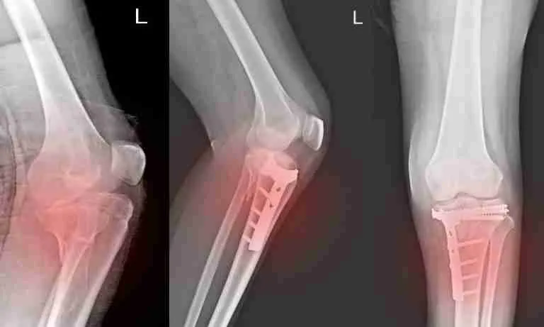 Fractures Treated at Orthopedic Urgent Care