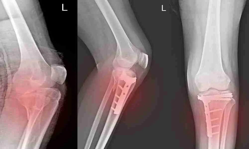 Fractures Treated at Orthopedic Urgent Care